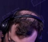 TheBaldening