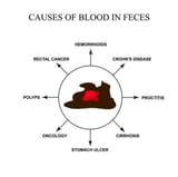 red-blood-in-stool-gia