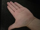 post skin