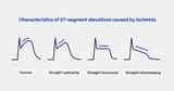 STEMI-ECG-Criteria-ST-elevations-caused-by-ischemia-2-2-1024x538