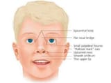 Characteristic-facial-features-in-a-child-with-fetal-alcohol-syndrome-These-includes-a