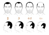 norwood scale