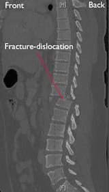 a00368f05_fracture-dislocation_resize-compressor_kh