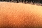 Goosebumps