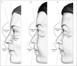Lateral-views-including-specified-facial-angle-measurments-of-the-average-North
