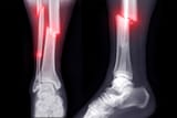 Compound-Fracture