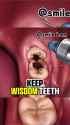 wisdom teeth_thumb.jpg