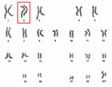 Human_male_karyotpe_high_resolution_-_Chromosome_2