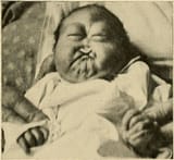 Congenital_absence_of_nose