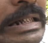 top and bottom sets of teeth