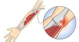 golfers-elbow800-1